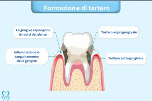 Igiene Orale - Formazione di Tartaro Igiene dentale